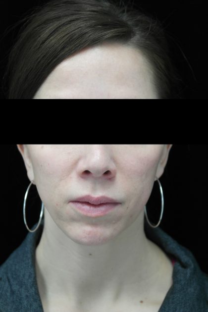 Chin Implants Before & After Patient #14816