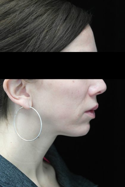 Chin Implants Before & After Patient #14816