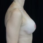 Breast Revision Before & After Patient #14712