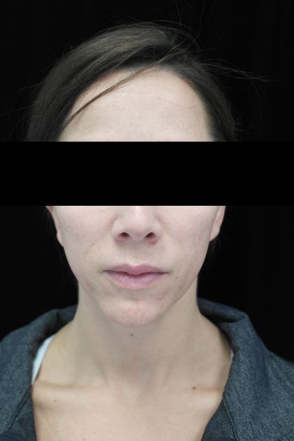 Chin Implants Before & After Patient #14816