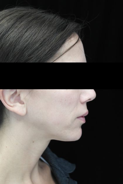 Chin Implants Before & After Patient #14816