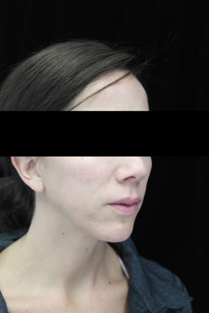 Chin Implants Before & After Patient #14816