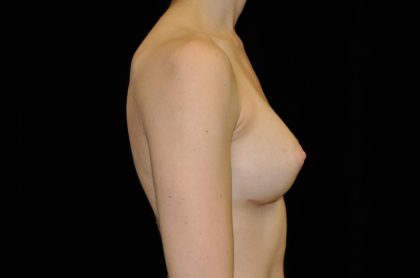 Breast Augmentation (Implants) Before & After Patient #14046