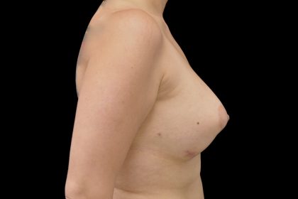 Breast Augmentation (Implants) Before & After Patient #14128