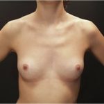 Breast Augmentation (Implants) Before & After Patient #14183