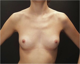 Breast Augmentation (Implants) Before & After Patient #14183