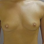 Breast Augmentation (Implants) Before & After Patient #14188
