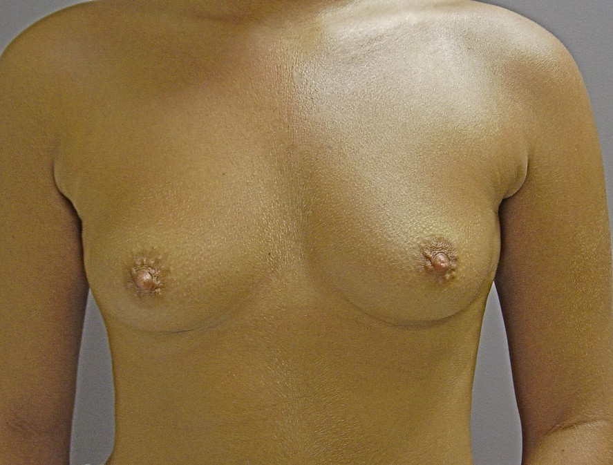 Breast Augmentation (Implants) Before & After Patient #14188