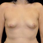 Breast Augmentation (Implants) Before & After Patient #14128
