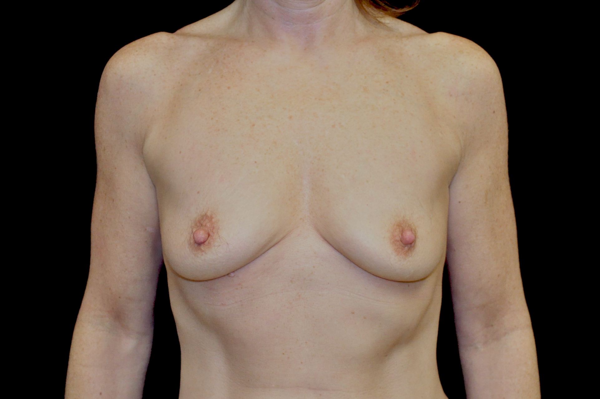 Breast Augmentation (Implants) Before & After Patient #14135