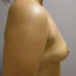 Breast Augmentation (Implants) Before & After Patient #14188