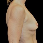 Breast Augmentation (Implants) Before & After Patient #14135