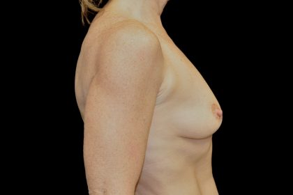 Breast Augmentation (Implants) Before & After Patient #14135