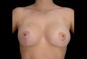Breast Lift Before & After Patient #14477