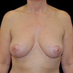Breast Lift Before & After Patient #14447