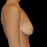 Breast Lift with Implants Before & After Patient #14514