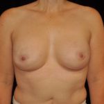 Breast Reconstructions Before & After Patient #15212