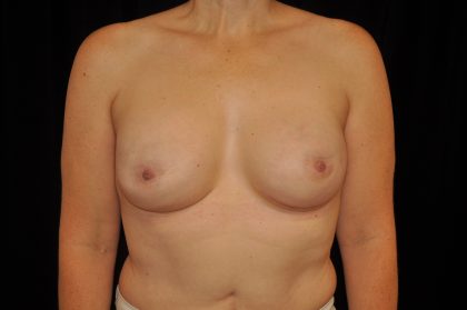 Breast Reconstructions Before & After Patient #15212