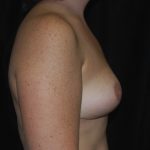 Breast Reduction Before & After Patient #14641