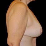 Breast Reduction Before & After Patient #14615