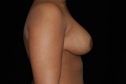 Breast Reduction Before & After Patient #14570