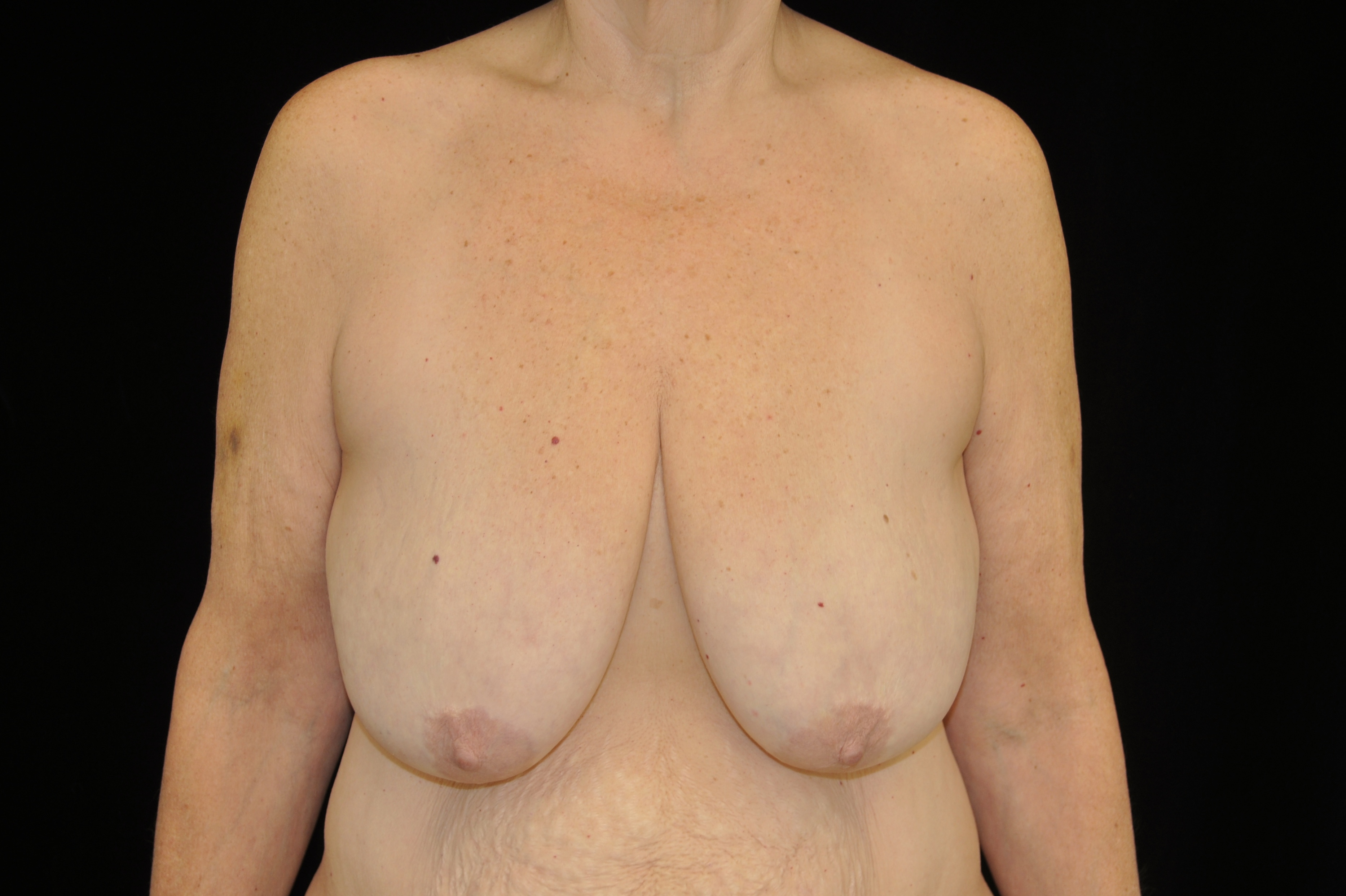 Breast Reduction Before & After Patient #14615