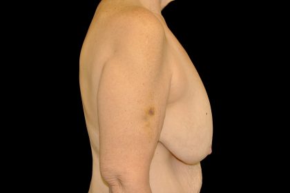 Breast Reduction Before & After Patient #14615