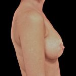 Breast Augmentation (Implants) Before & After Patient #14142