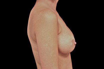 Breast Augmentation (Implants) Before & After Patient #14142