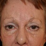 Browlift Before & After Patient #14749