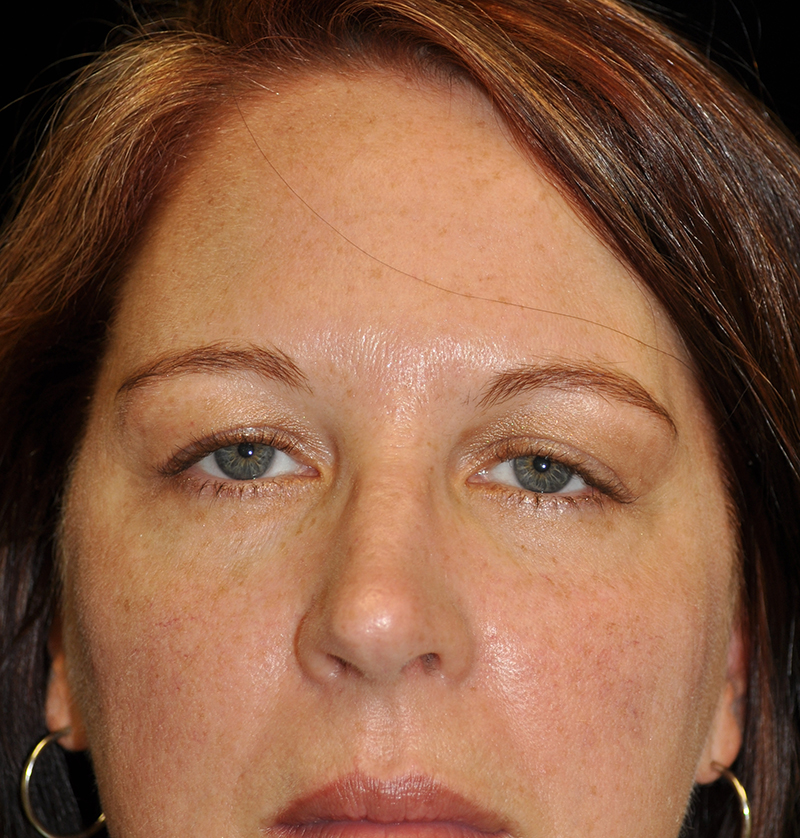 Browlift Before & After Patient #14738