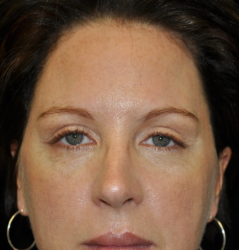Browlift Before & After Patient #14738