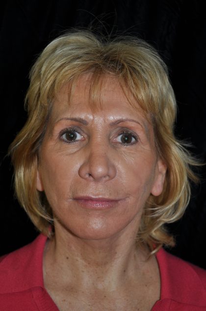 Facelift Before & After Patient #14923