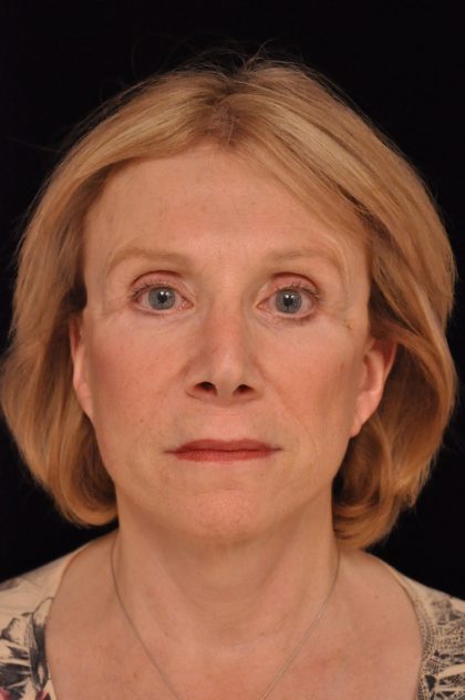 Facelift Before & After Patient #14860
