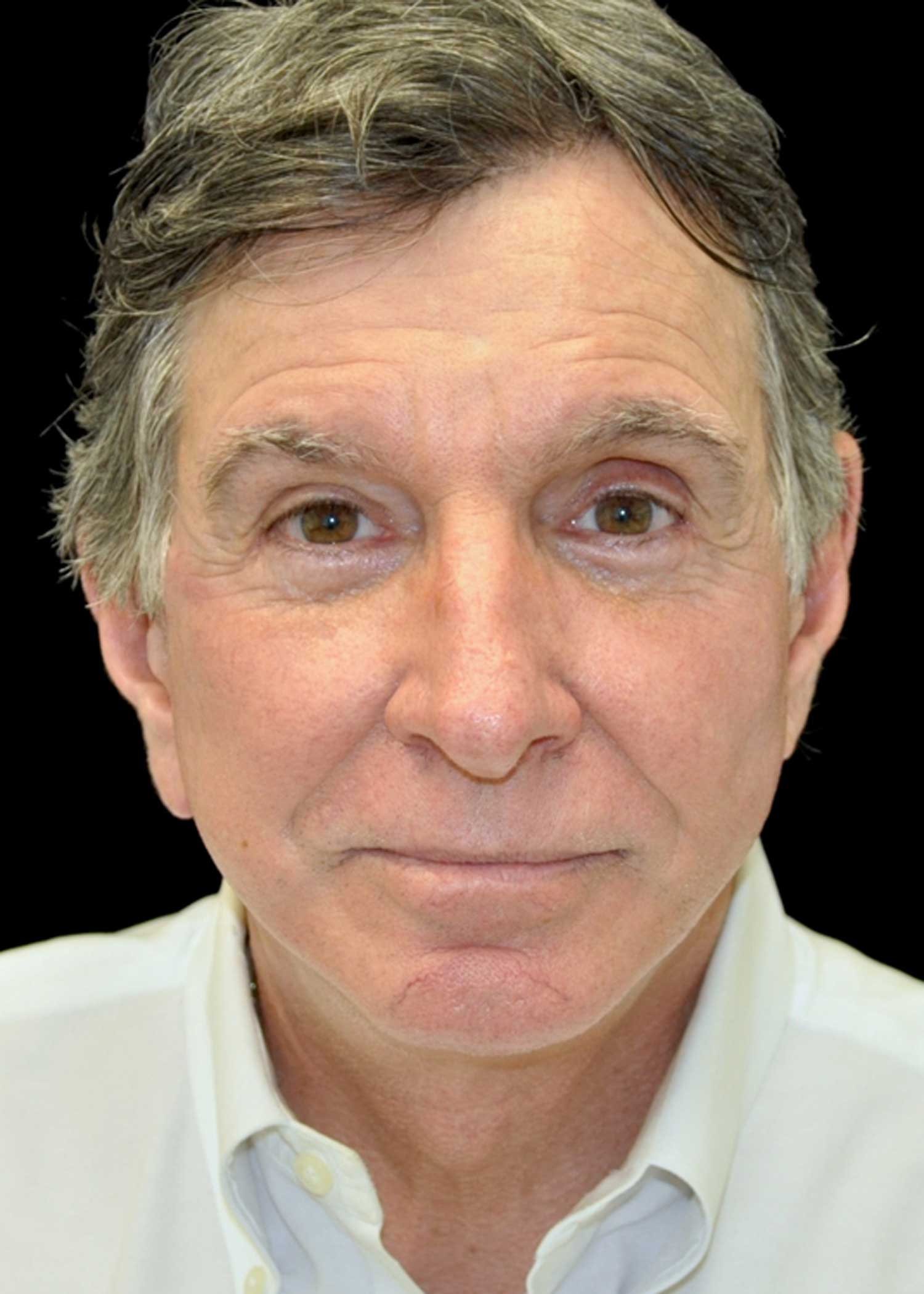 Facelift Before & After Patient #14848