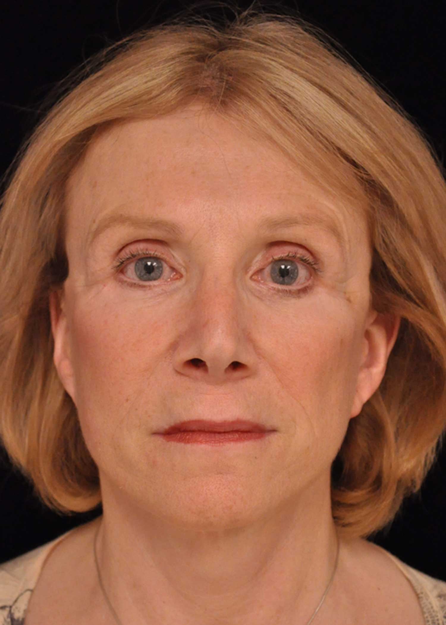 Facelift Before & After Patient #14860