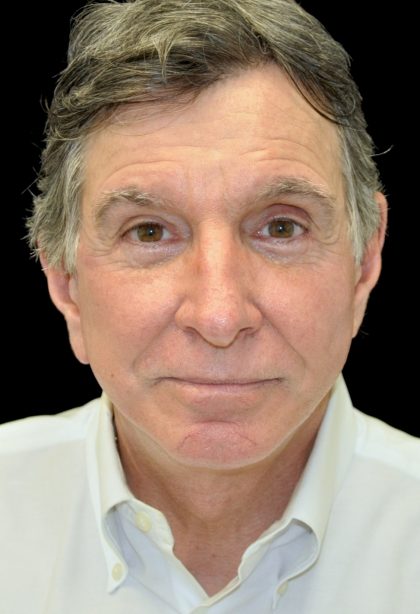 Facelift Before & After Patient #14848