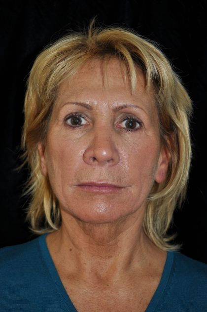 Facelift Before & After Patient #14923