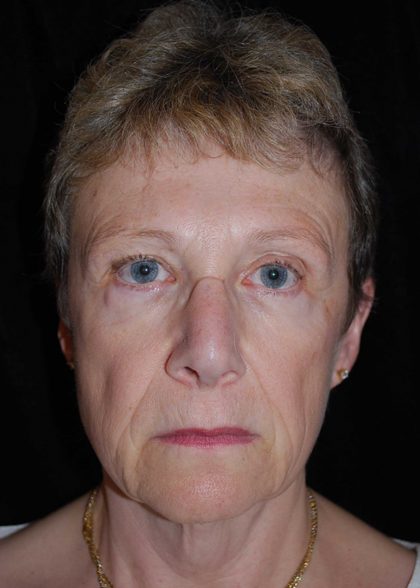 Facelift Before & After Patient #14860