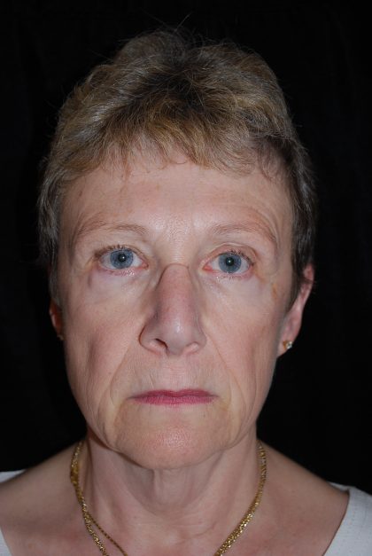 Facelift Before & After Patient #14860