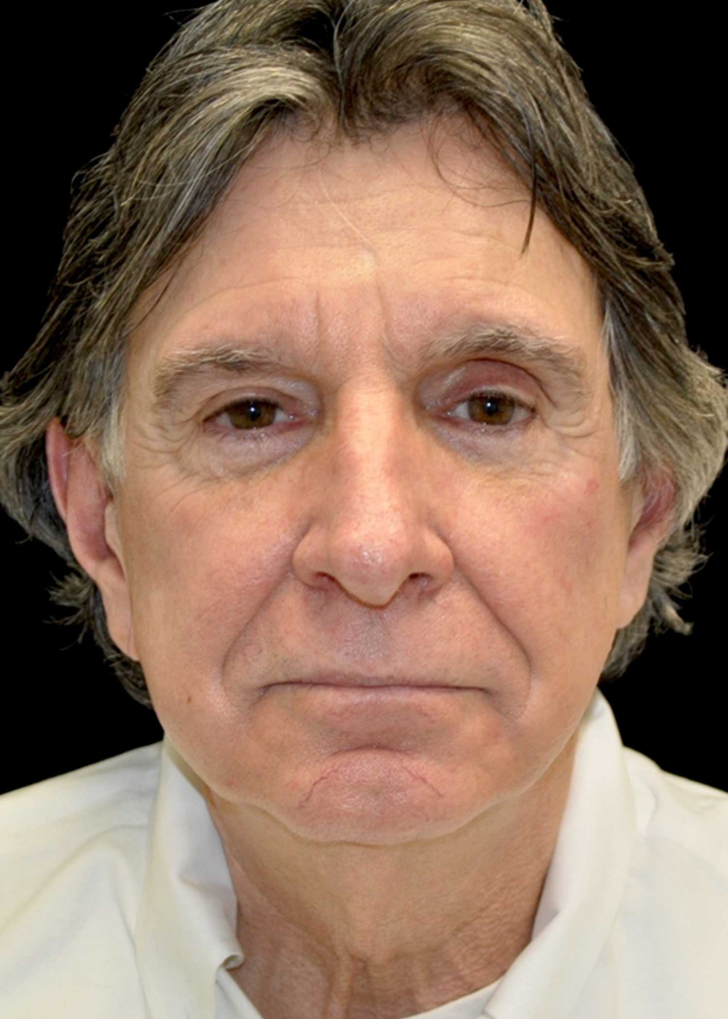 Facelift Before & After Patient #14848