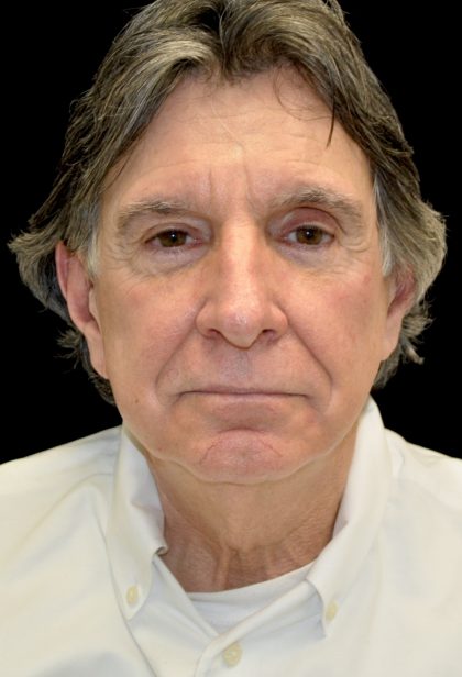 Facelift Before & After Patient #14848