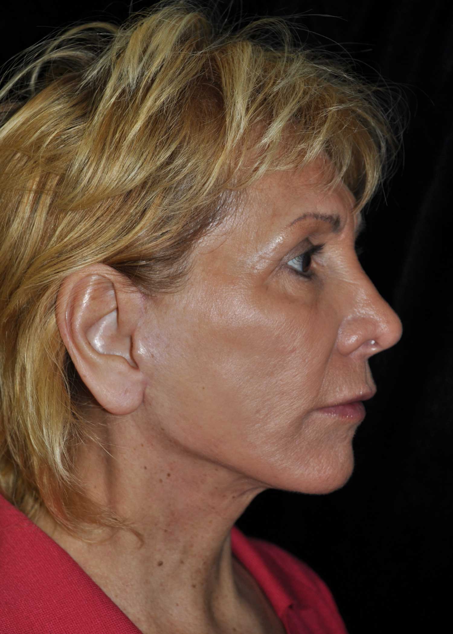 Facelift Before & After Patient #14923