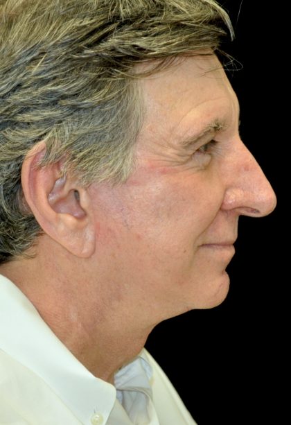 Facelift Before & After Patient #14848