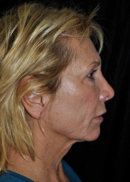 Facelift Before & After Patient #14923