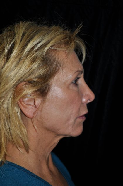 Facelift Before & After Patient #14923