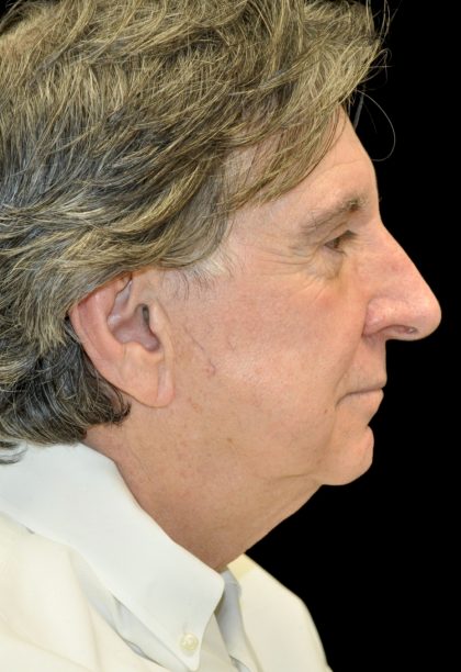 Facelift Before & After Patient #14848