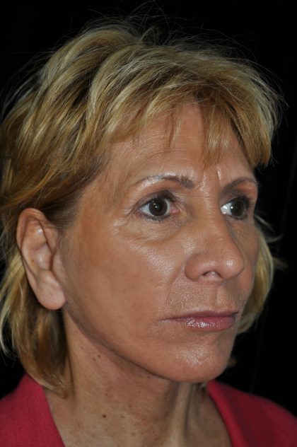 Facelift Before & After Patient #14923