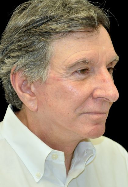 Facelift Before & After Patient #14848