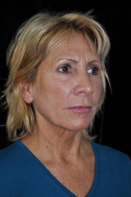 Facelift Before & After Patient #14923